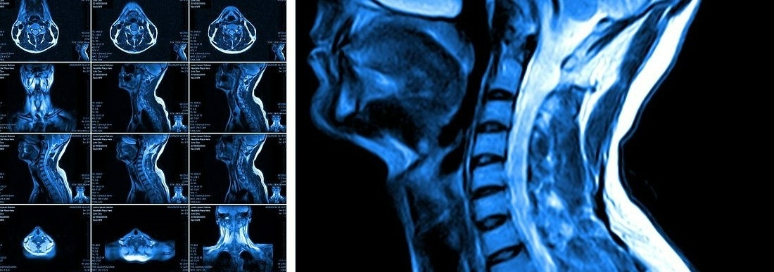 mri neck scan